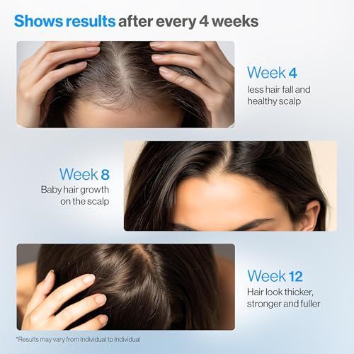 Premium Rozemarijn Anti-Haarui - Hair Care For Hair Fall recensie en prijs